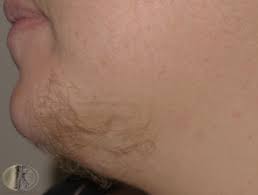 Some growth is typical and has no links to conditions that cause hirsutism. Excessive Hair Dermnet Nz