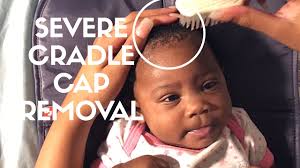 Here's some information to help you prepare for your visit. Newborn Cradle Cap Removal Rash All Over Youtube