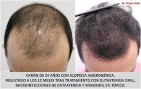 How do i grow a beard faster? Dutasteride And Minoxidil Before And After Photos Hair Loss Cure 2020