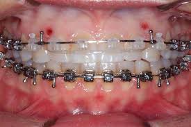 Some people with braces may be shy about smiling. The Gummy Smile Dilemma An Often Untreated Condition Dentistry Online