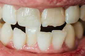 Image result for Tooth Fracture