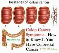 Pin On Colorectal Cancer