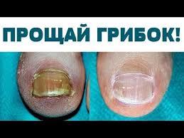 как сделать мазь от грибка ногтей из яйца и уксуса Pin Na Doske Zdorove