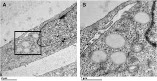 Nehoda na d1 u klimkovic. Frontiers Proteomic Characterization Of Cytoplasmic Lipid Droplets In Human Metastatic Breast Cancer Cells Oncology