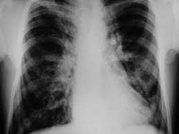 Cystická fibróza je závažné a nevyléčitelné dědičné onemocnění způsobené mutacemi v genu cftr , který řídí činnost tzv. Cysticka Fibroza V Odpoledni Session Radio Wave