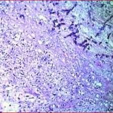 L'aspergillus est un type de champignon trouvé abondamment autour de nous (à l'intérieur ainsi qu'à l'extérieur). Image Histologique D Une Aspergillose Pulmonaire Hes Grossissement Download Scientific Diagram