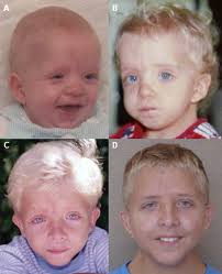 Image result for noonan syndrome