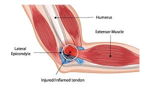 Image result for Epicondyle Injection