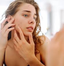 Image result for acne face