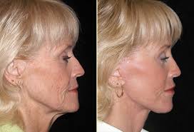 If you have jowls, you've probably been searching all over for makeup tricks for jowls that will make your face appear slimmer and hide those jowls! Treat Sagging Skin Around Neck Jowls Walnut Creek Greenbrae Robert Aycock Md Aycock Md