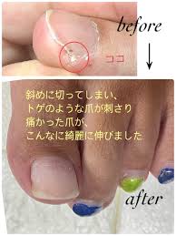 バイアスカット – be with you｜足の爪トラブル・巻き爪・肥厚爪