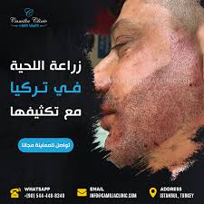 Beard Transplant In Turkey Beard Transplant Beard Transplant