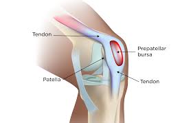 Image result for Bursitis