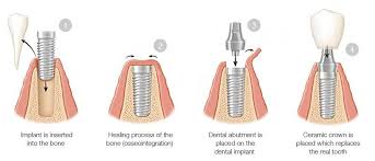 Image result for dental implant
