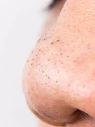 How long are your favorite video games? What Are Blackhead Pimples Actually Made Of And What S Inside Allure