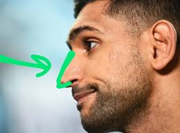 Are MMA fighters getting their nose bone removed?