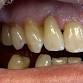 MiYo-Superior Esthetics for Monolithic Crowns event image