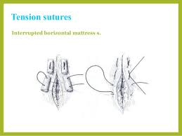 Image result for simple continuous suture pattern