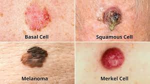 You will find out more about body changes and other things that can signal a problem that may need medical care. Types Of Skin Cancer Melanoma Basal And Squamous Cell Carcinoma Everyday Health
