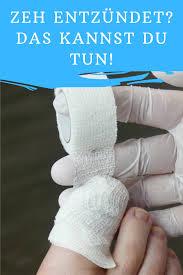 Zeh Entzundet Das Kannst Du Tun Zehen Zehennagel Eingewachsene Fusszehen