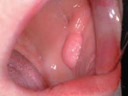 While throat cancer used to occur primarily in older patients with a history of alcohol and tobacco use, that's there's no doubt that robotic surgery is better for the patient than more invasive approaches like how does md anderson determine of the best treatment for each patient with throat cancer? Oral Cancer Prevention Mills Dental Care