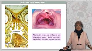 Presentación de labio paladar hendido, exposición hecha por un estudiante de medicina de 3er año para el hospital general regional de la perla en cd, nezahualc… Fisura Palatina Paladar Hendido Youtube