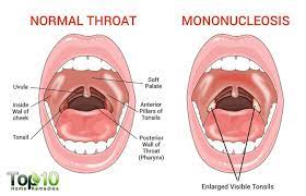 Mononucleosis Explained: Causes, Symptoms And Natural Remedies | Top 10  Home Remedies