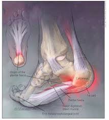 Managing Plantar Fasciitis And Other Heel Pain Rheumatology Network