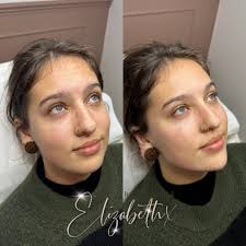 My beautiful client Sophie came for her first ever filler appointment today  and we opted for a 5ml cheeks, chin & jawline package. Sophie highlighted  to me a few of her insecurities
