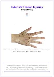 Image result for Elson Extensor Tendon Test
