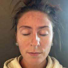 LOVE this before and after! She wanted to wear makeup for events and work  but had inflamed acne and hyperpigmentation. She struggled for years until  we started the acne series! Look at