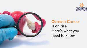 Most women get it without being at high risk. Ovarian Cancer Causes Symptoms Diagnosis And Treatments