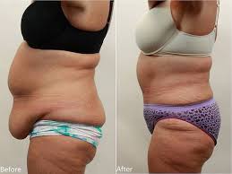 Pin On Tummy Tuck Surgery