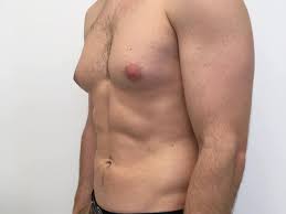 Gynecomastia: Know Everything About This Common Condition Seen In Boys And  Men | TheHealthSite.com