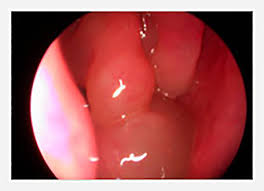 Nasal polyps are noncancerous growths that develop in the lining of the nose and surrounding sinuses. Nasal Polyps Symptoms And Treatment Sinusitis Singapore Dr Kenny Pang