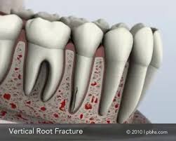 Image result for Tooth Fracture
