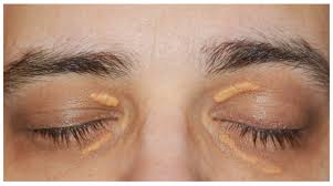 Image result for xanthelasma of eyelid