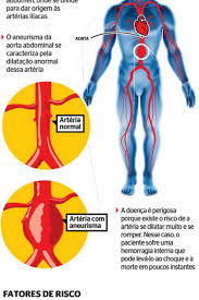 Sua forma usual é a de um saco, seu diâmetro até vários centímetros. Campanha Na Cinelandia Alerta Para Aneurisma Da Aorta Abdominal Doenca Silenciosa Que Pode Ser Fatal Saude E Ciencia Extra Online