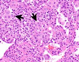 Spindle cells arranged in a patternless pattern (he â400). Pathology Outlines Diffuse Malignant Mesothelioma