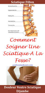 Pin On Sciatique