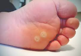 They grow in clusters or singly. Current And Emerging Concepts In Wart Treatment Podiatry Today