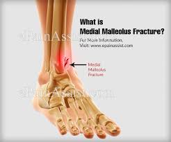 You probably know the medial malleolus as the bump that protrudes on the inner side of your ankle. Medial Malleolus Fracture Causes Symptoms Treatment Recovery Time Diagnosis
