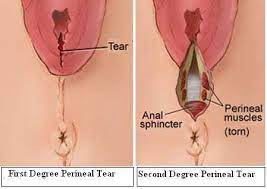 Perineal Tear Why Does This Injury Occur