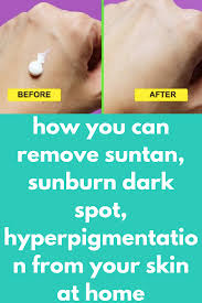 Dermatologists explain how to get rid of peeling skin fast and safely—and how to prevent it in the first how to safely treat peeling skin after a sunburn, according to dermatologists. How You Can Remove Suntan Sunburn Dark Spot Hyperpigmentation From Your Skin At Home Today I Am Going To Sha Tanning Skin Care Peeling Skin Skin Care Secrets