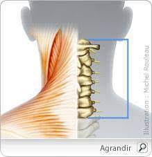 Elle est provoquée par la contraction involontaire d'un ou de plusieurs muscles. Le Torticolis Qu Est Ce Que C Est