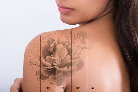 Keloid removal treatment works by shrinking the keloid. Tattoo Removal Singapore Arium Clinic Medical Aesthetics