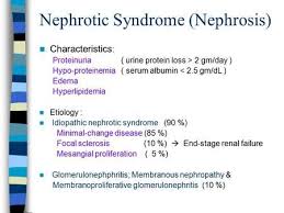 Idiopathic nephrotic syndrome (ins) is the commonest type; Nephrotic Syndrome Nephrosis Characteristics Proteinuria Urine Protein Loss 2 Gm Day Hypo Proteinem In 2021 Nephrotic Syndrome Oedema End Stage Renal Failure