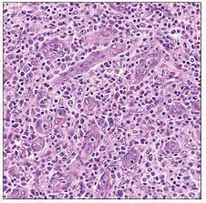 It is characterized by a unique clinical presentation and distinct pathologic and molecular features. Angioimmunoblastic T Cell Lymphoma Basicmedical Key