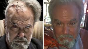 Son transforms dad's brain-op stitches into Bond villain look