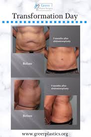Tummy Tuck In Mentor Abdominoplasty Greer Plastic Surgery In 2020 Plastic Surgery Tummy Tucks Abdominoplasty
